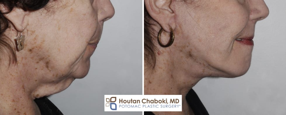 Deep Neck Lift Surgery  Potomac Plastic Surgery