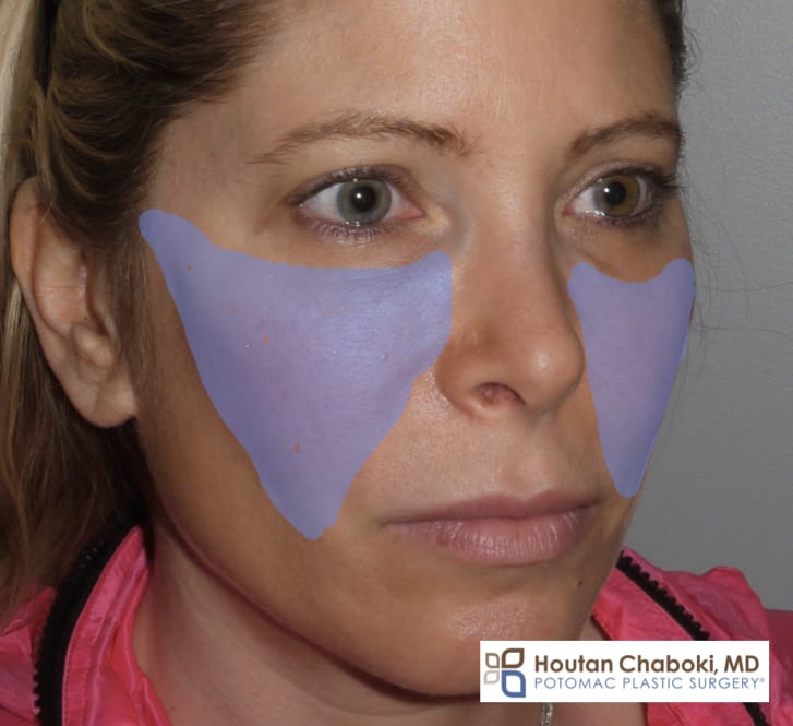 Blog post - round cheeks filler injection enhancement