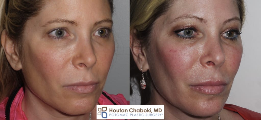 Blog post - round cheeks filler injection enhancement