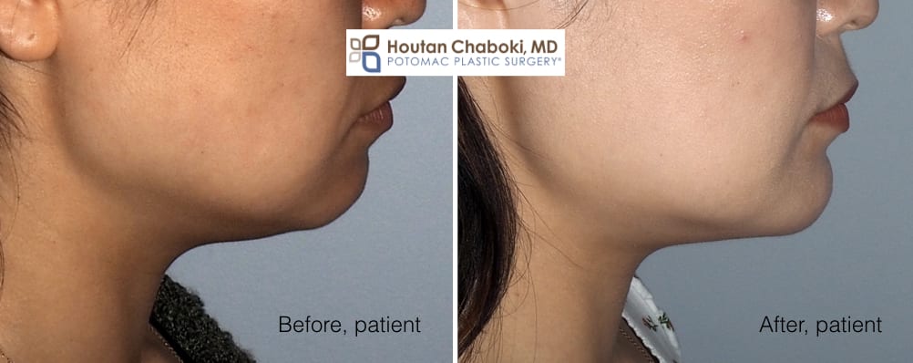Blog post - before after chin surgery augmentation implant neck lift liposuction facelift
