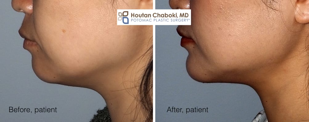 Blog post - before after chin surgery augmentation implant neck lift liposuction facelift