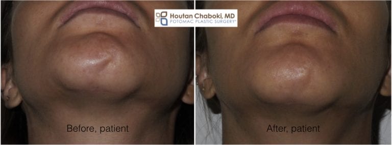 4 Injections to Treat Scars