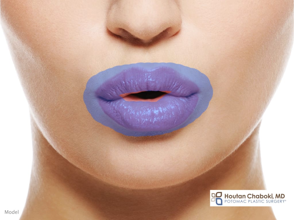 Blog - lip enhancement injection facial filler ideal lip shape attractive lip flip Botox Dysport