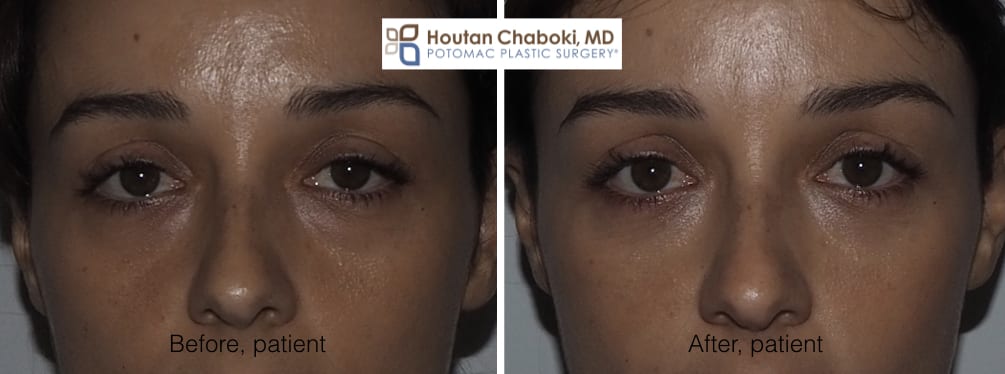 Blog post - before after photos nonsurgical eyelid rejuvenation lower filler Botox Dysport