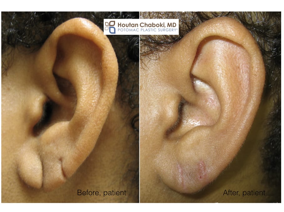 Split Earlobe Repair with Plastic Surgery