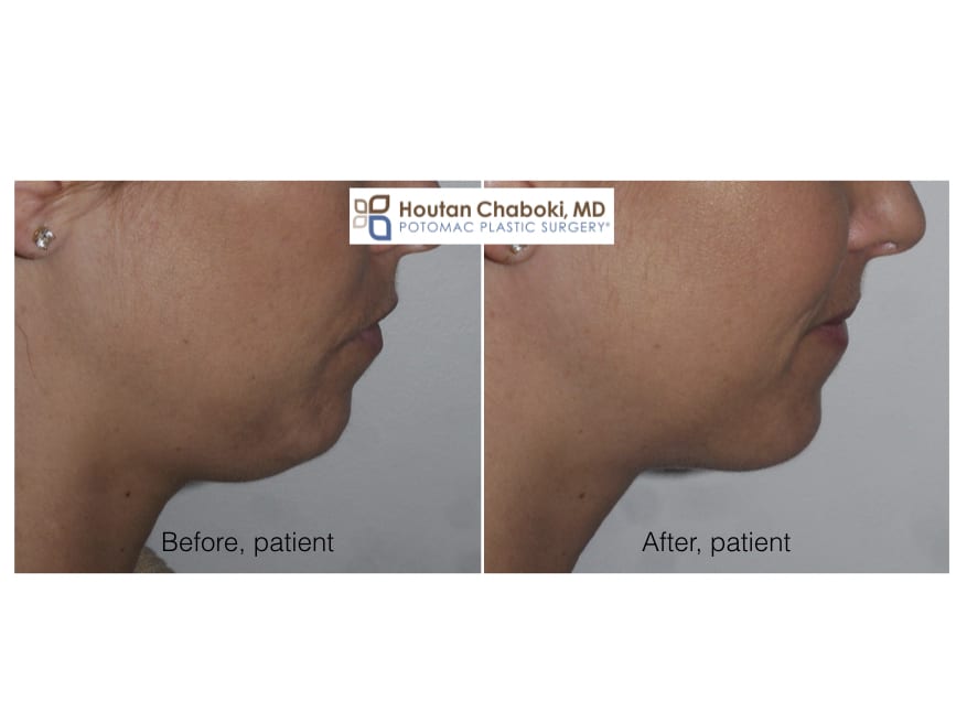 Blog post - 3 stitch neck lift liposuction double chin