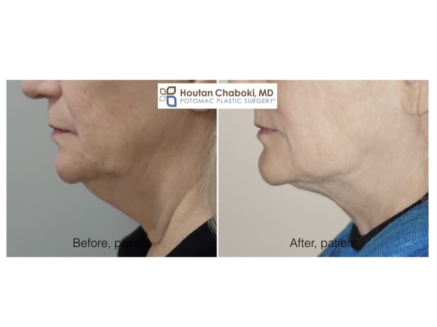 Jawline Contouring  Virginia, Washington D.C. and Maryland