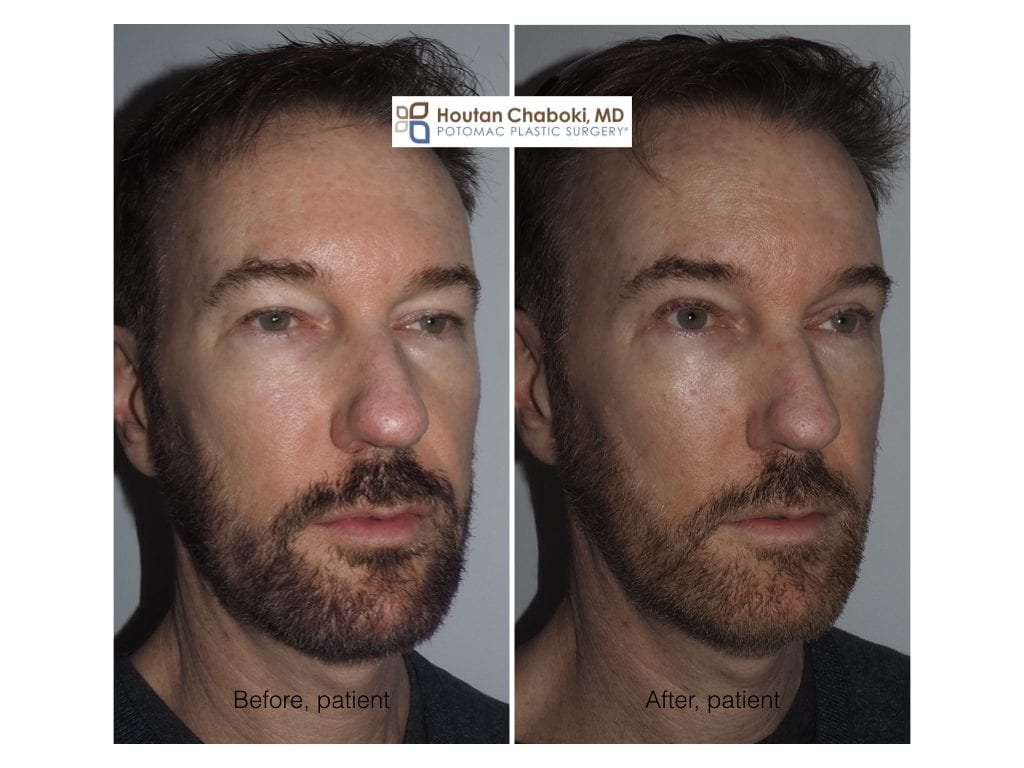 Blog post - eye rejuvenation eyelid surgery men male eye bag