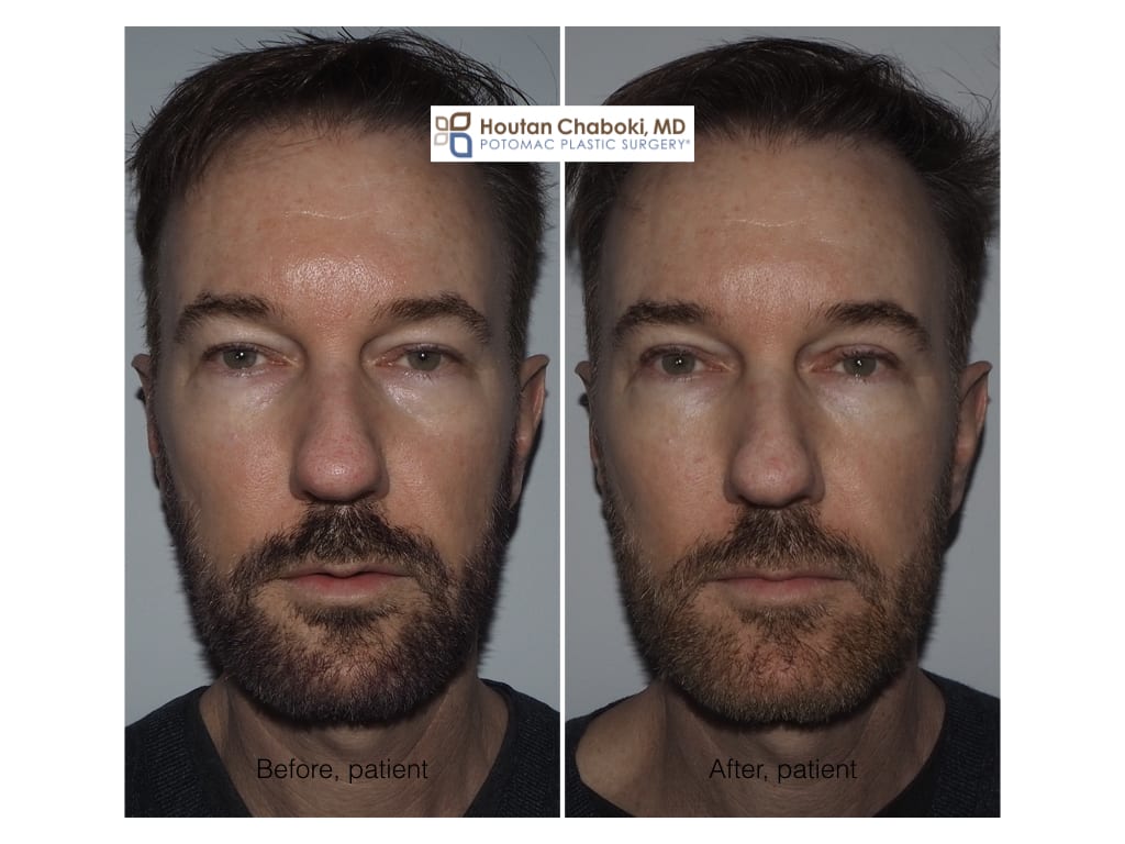 Blog post - eye rejuvenation eyelid surgery men male eye bag