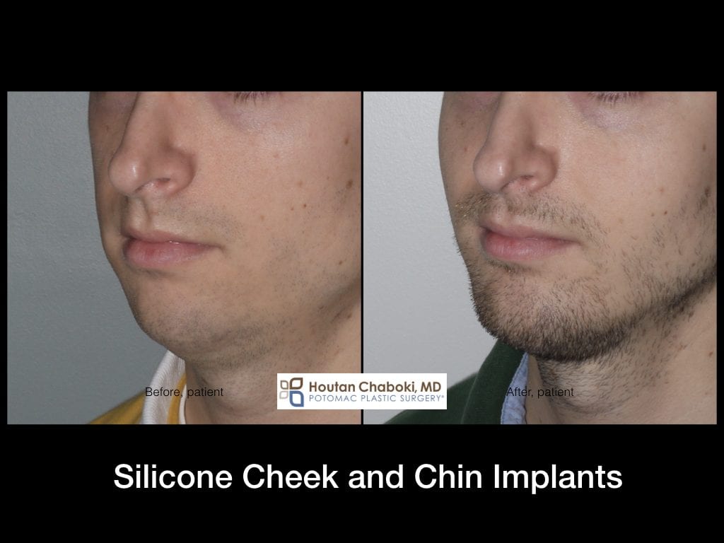 Silicone cheek and chin implants plastic surgery Washington DC