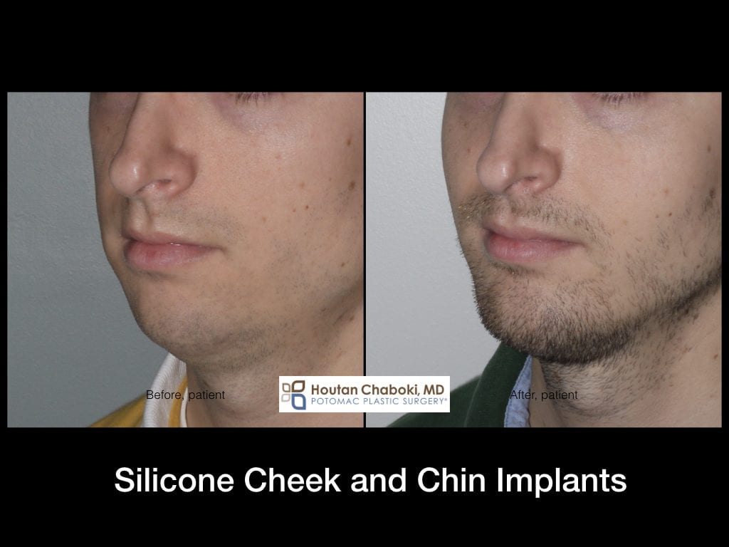 cheekbone implants men before and after