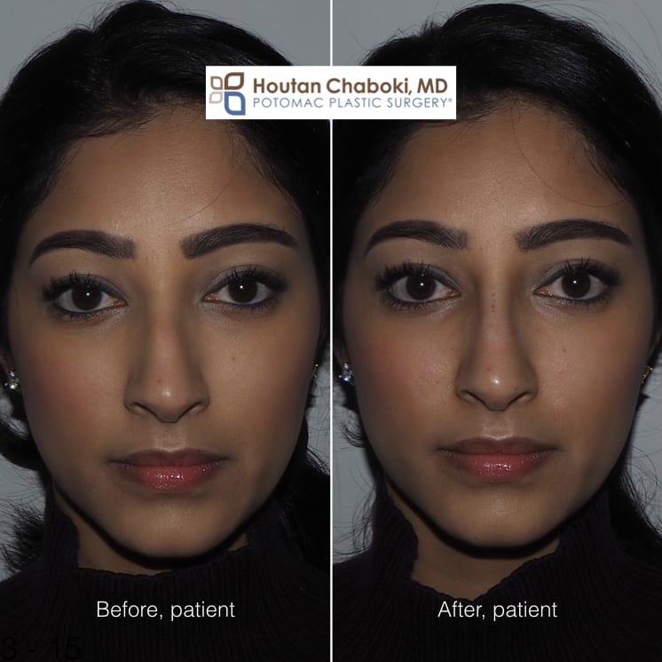 Blog post - photos before after filler injection nose job nonsurgical rhinoplasty bump