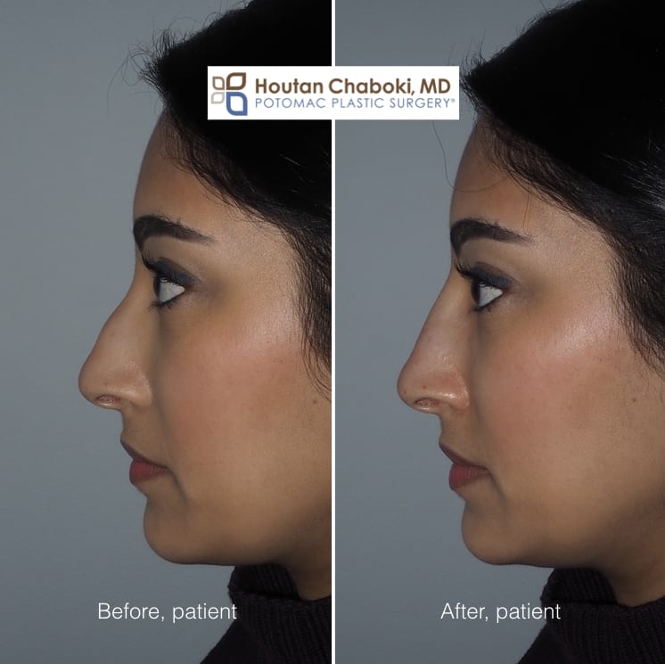 Blog post - photos before after filler injection nose job nonsurgical rhinoplasty bump