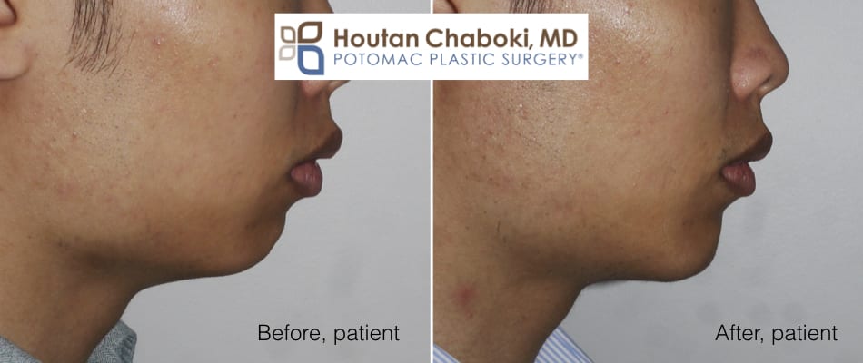 Blog post - before after chin augmentation implant potomac plastic surgery Washington DC Chaboki