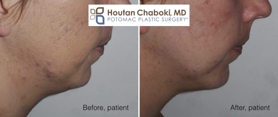 Blog post - before after chin augmentation implant potomac plastic surgery Washington DC Chaboki