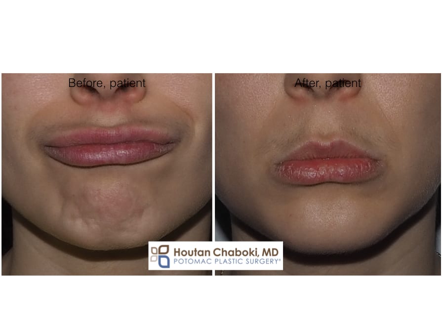 Blog post - before after photos Botox chin dimple injection plastic surgery