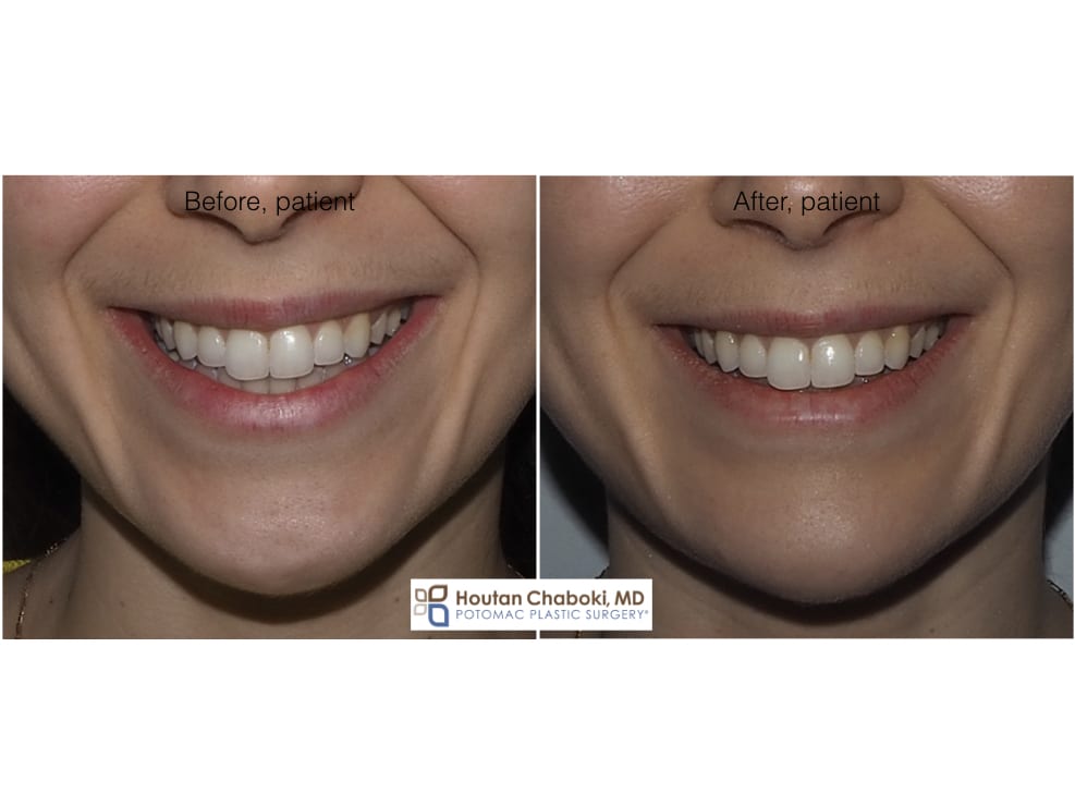 Blog post - before after photos Botox chin dimple injection plastic surgery