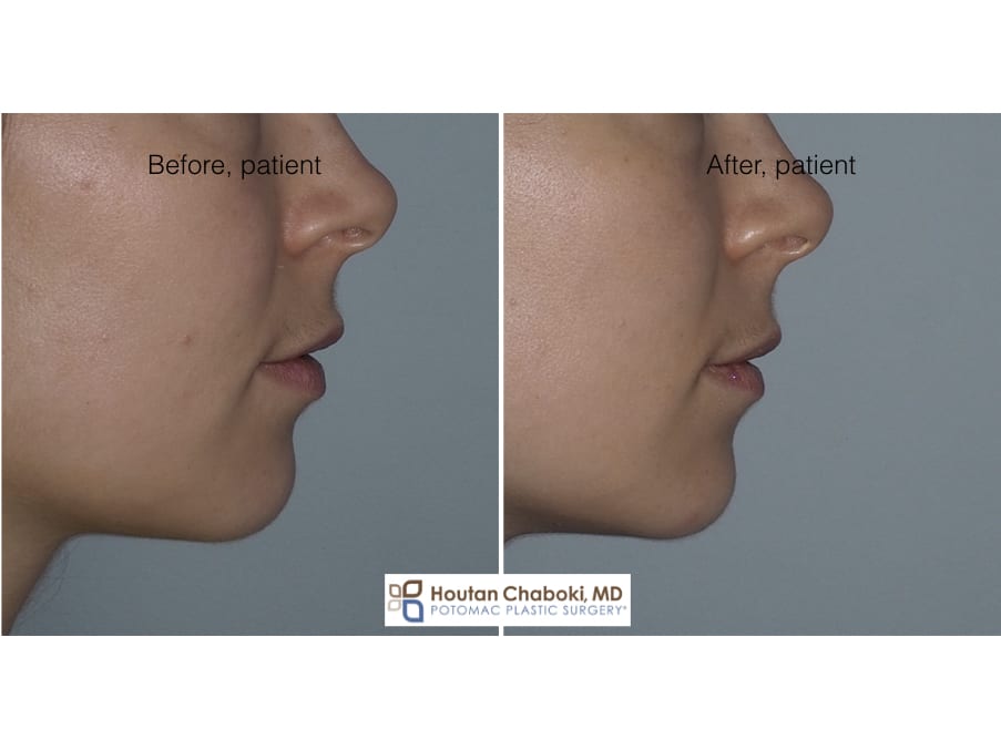 Blog post - before after photos Botox chin dimple injection plastic surgery