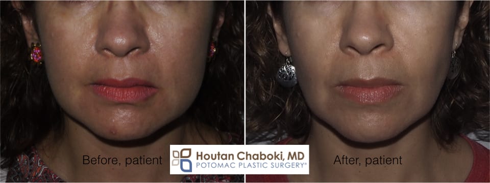 Blog post - before after plastic surgery photos cheek fat reduction buccal facial sculpting contour