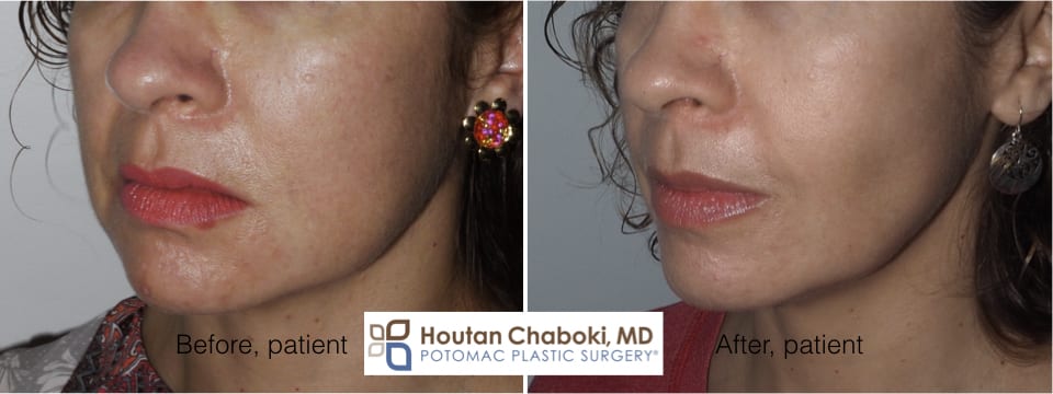 Contouring Cheeks with Fat Reduction