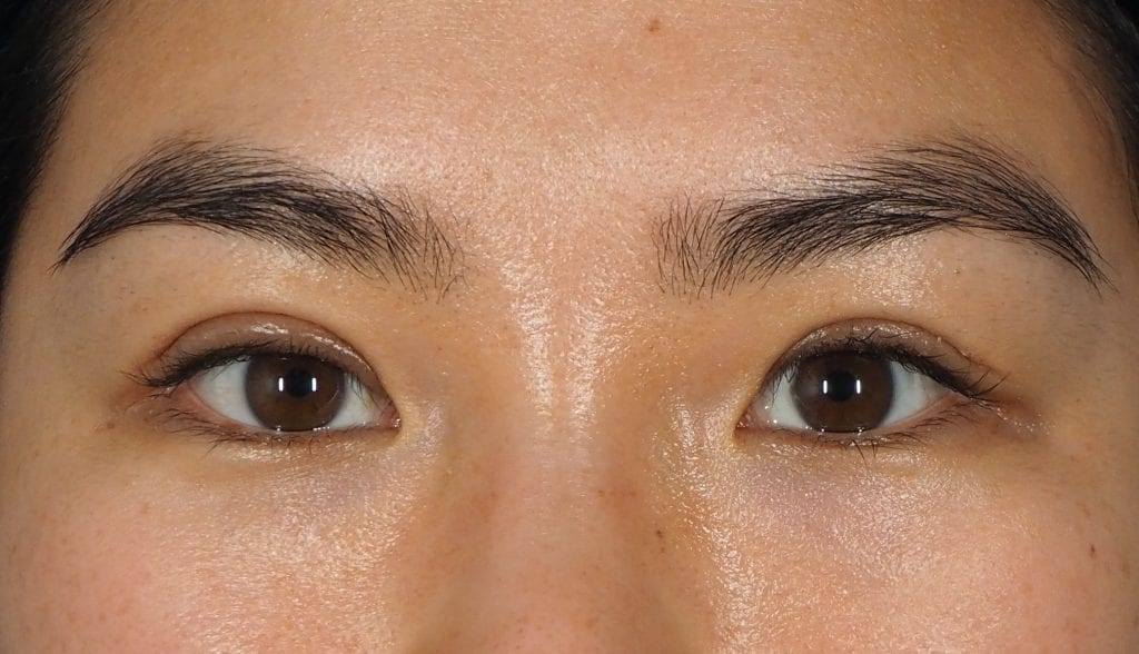double eyelid surgery recovery
