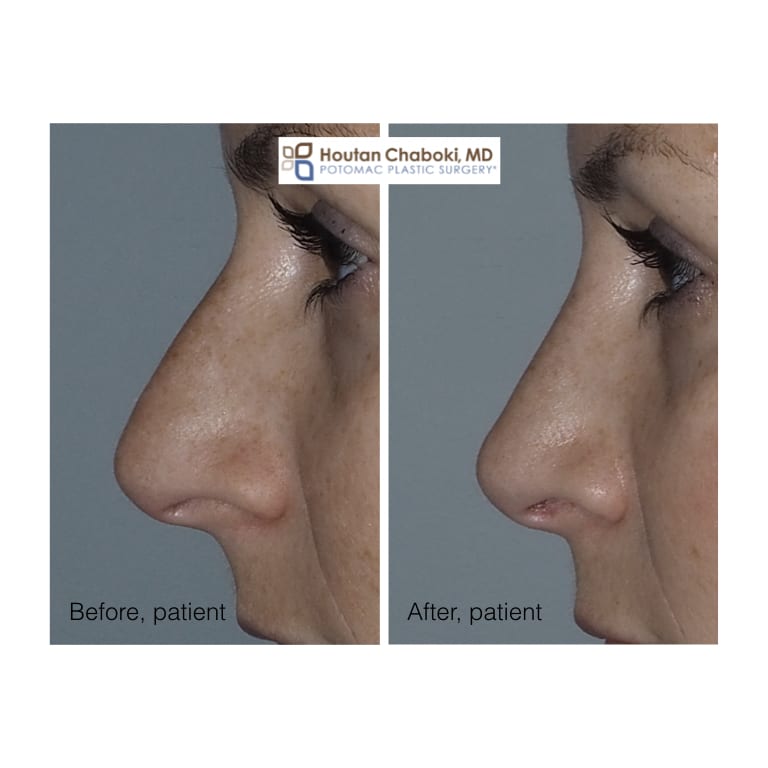 Blog post - before after photos preservation rhinoplasty bump nose jose plastic surgery