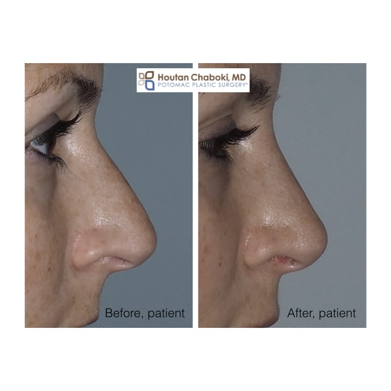 Blog post - before after photos preservation rhinoplasty bump nose jose plastic surgery