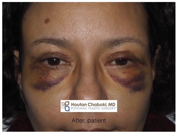 Blog post - before after photos recovery plastic surgery nose eyes chin neck swelling bruising