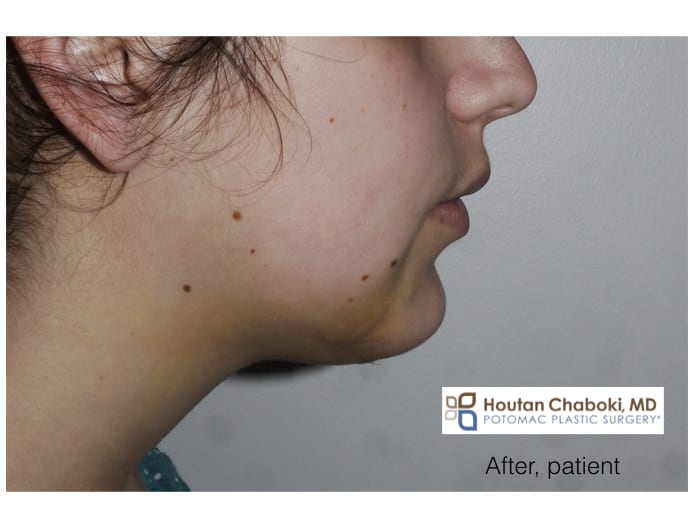 Blog post - before after photos recovery plastic surgery nose eyes chin neck swelling bruising