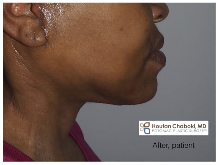 Blog post - before after photos recovery plastic surgery nose eyes chin neck swelling bruising