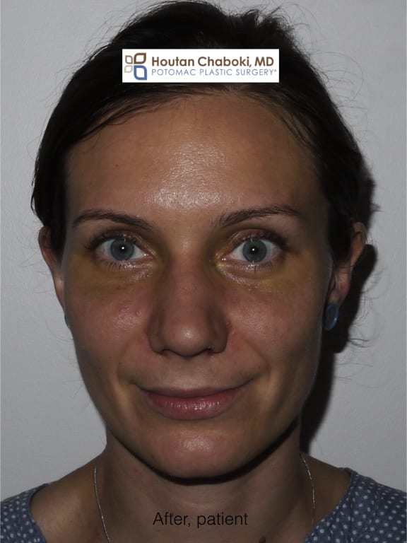 Blog post - before after photos recovery plastic surgery nose eyes chin neck swelling bruising