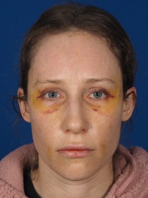 fat transfer, fat injection, lower blepharoplasty, eyelid surgery, eye bag, dark circle, under eye, lips, cheeks, face, temple, downtime, bruising, swelling, early recovery, recovery plastic surgery, cosmetic surgery