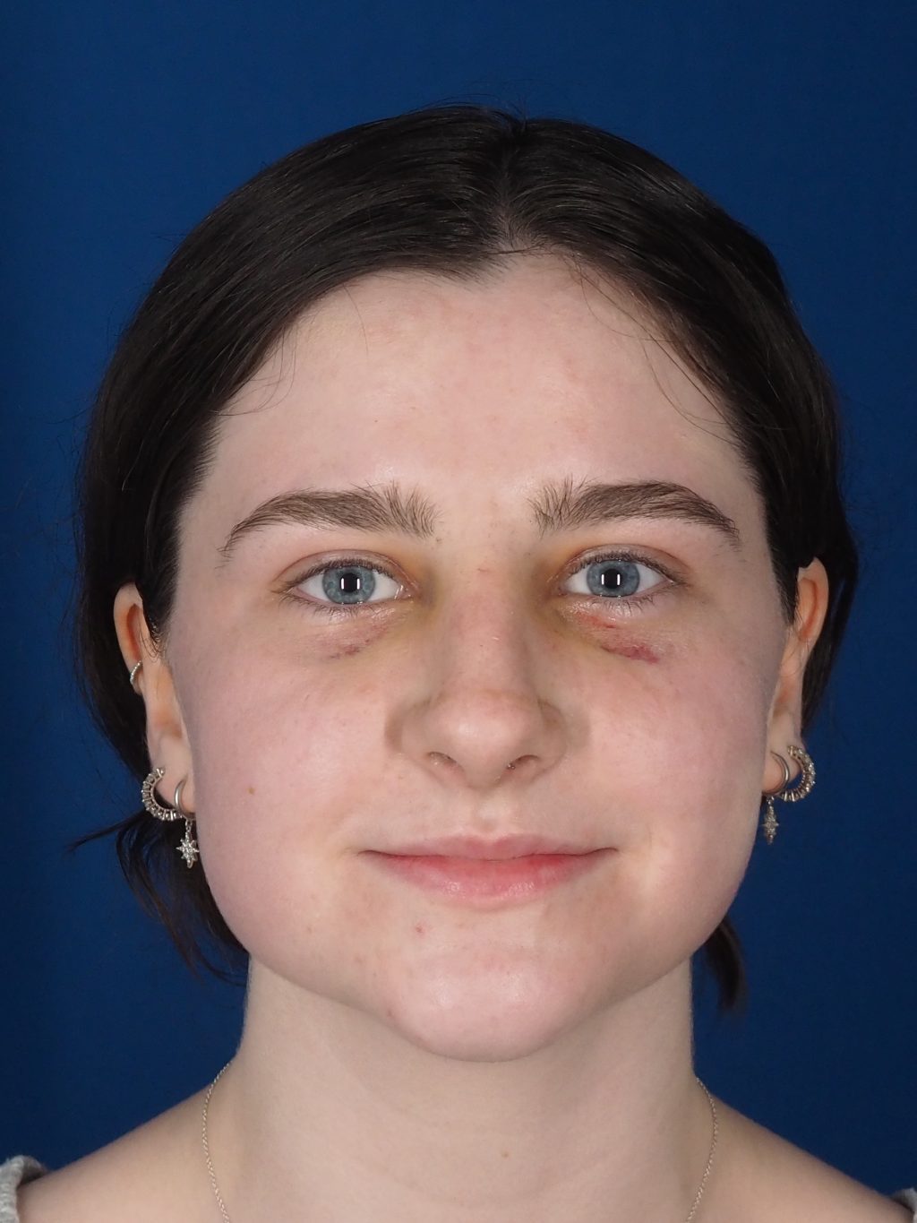rhinoplasty, nose job, nose surgery, bump, droopy tip