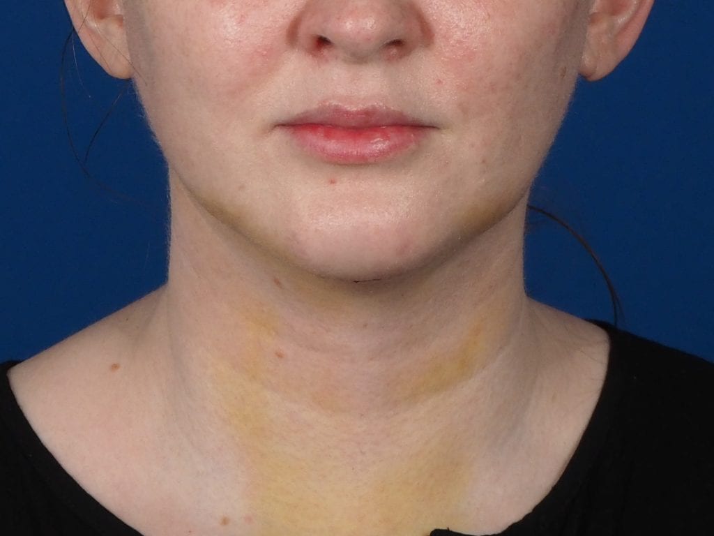 chin implant neck liposuction