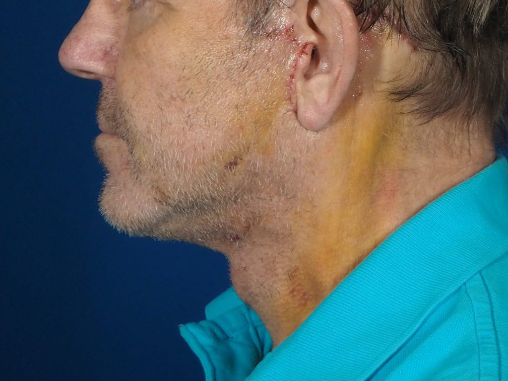 male neck lift recovery