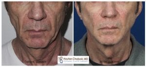 Before after male facelift neck lift chin liposuction facial fat transfer Chaboki plastic surgery