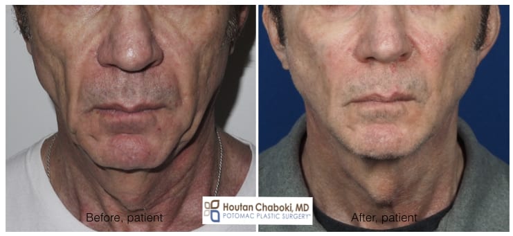 Before after male facelift neck lift chin liposuction facial fat transfer Chaboki plastic surgery