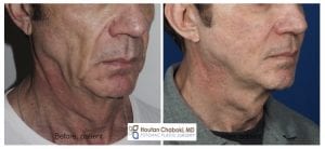 Before after male facelift neck lift chin liposuction facial fat transfer Chaboki plastic surgery