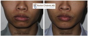 Blog post - chin augmentation implant surgery male man jawline