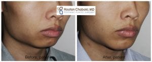 Blog post - chin augmentation implant surgery male man jawline