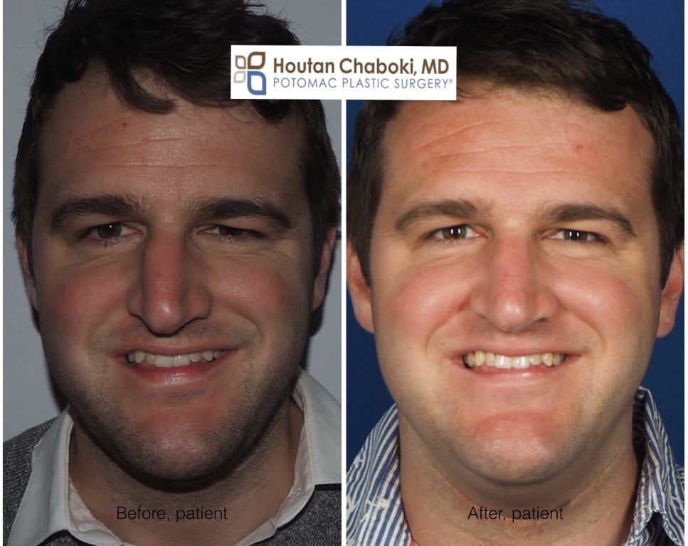 before after preservation rhinoplasty deviated nose septum closed plastic surgery DC