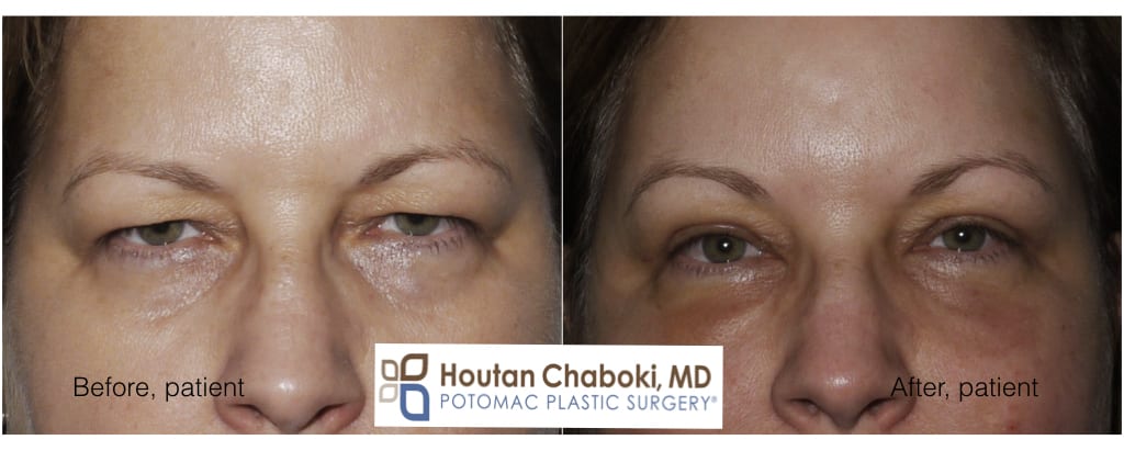 Before after brow lift upper eyelid surgery cosmetic plastic forehead Botox