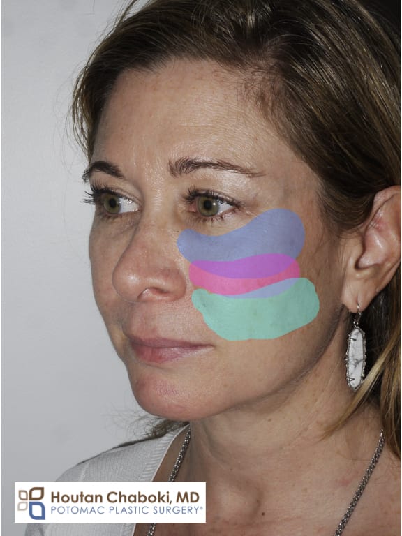 Blog post - Cheek augmentation filler fat transfer implant silicone facelift