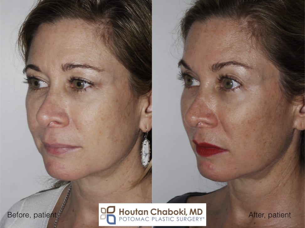 Blog post - Cheek augmentation filler fat transfer PRF implant silicone facelift