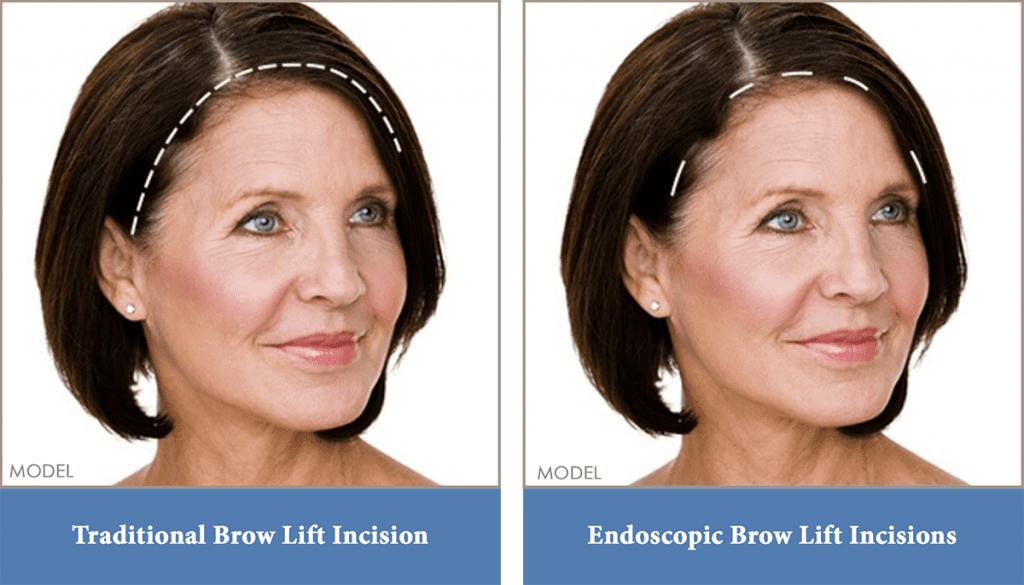 Brow lift incision