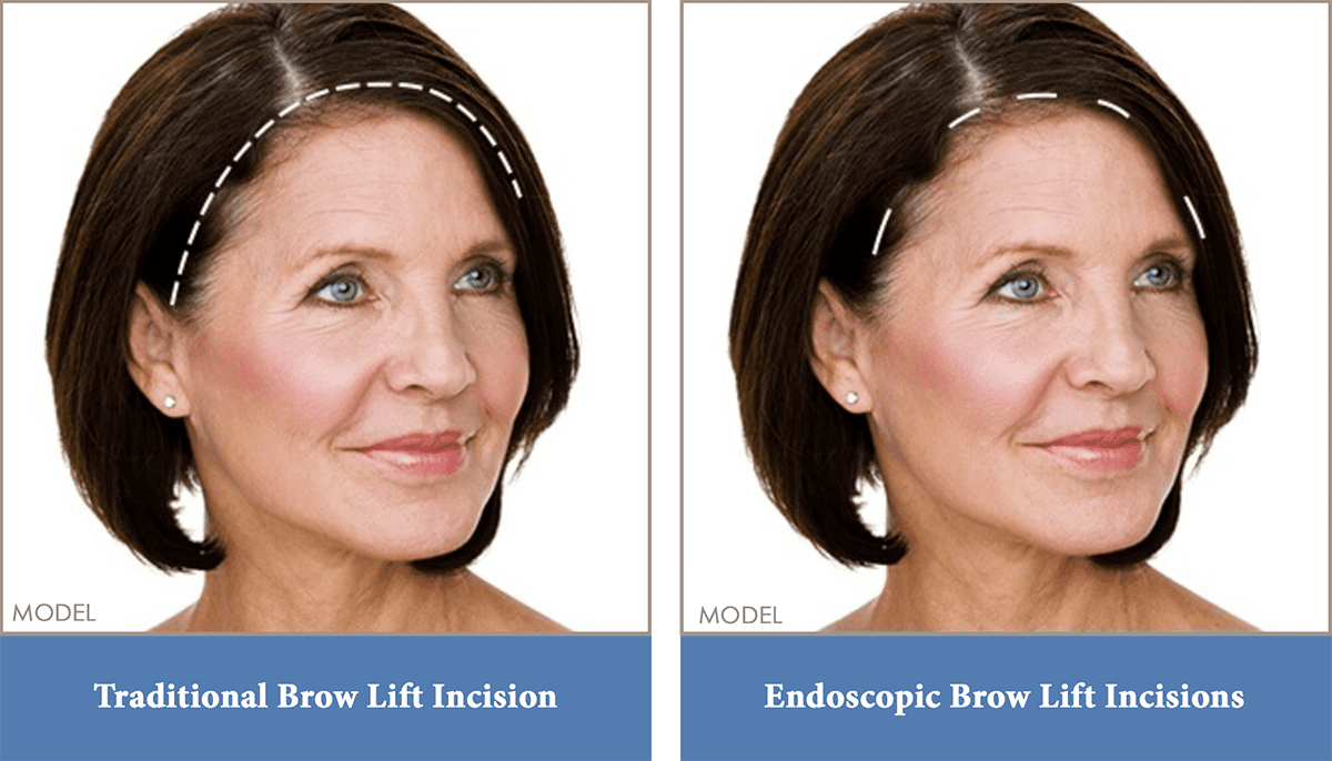 Brow (Forehead) Lift Washington, DC, & Arlington, VA Potomac Plastic