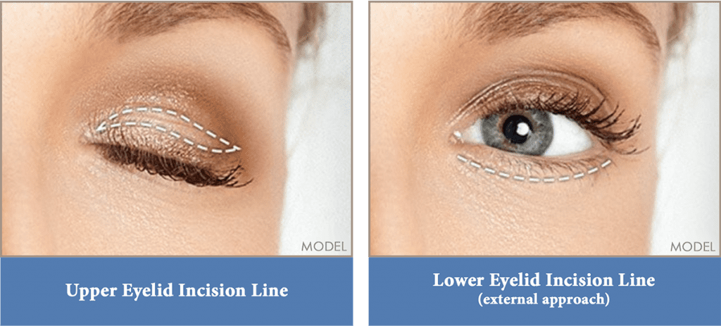 Upper eyelid incision line