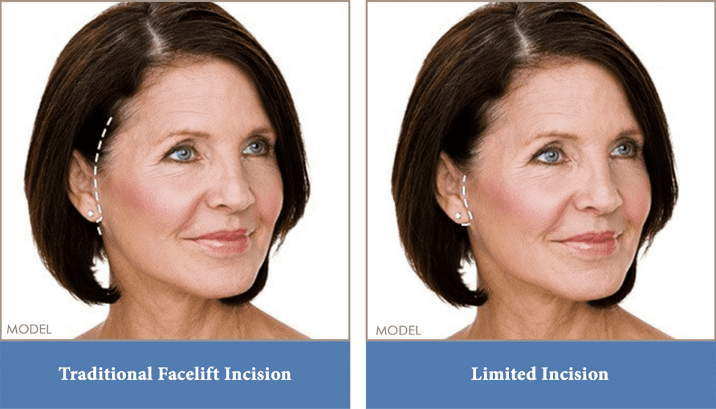 Facelift incision