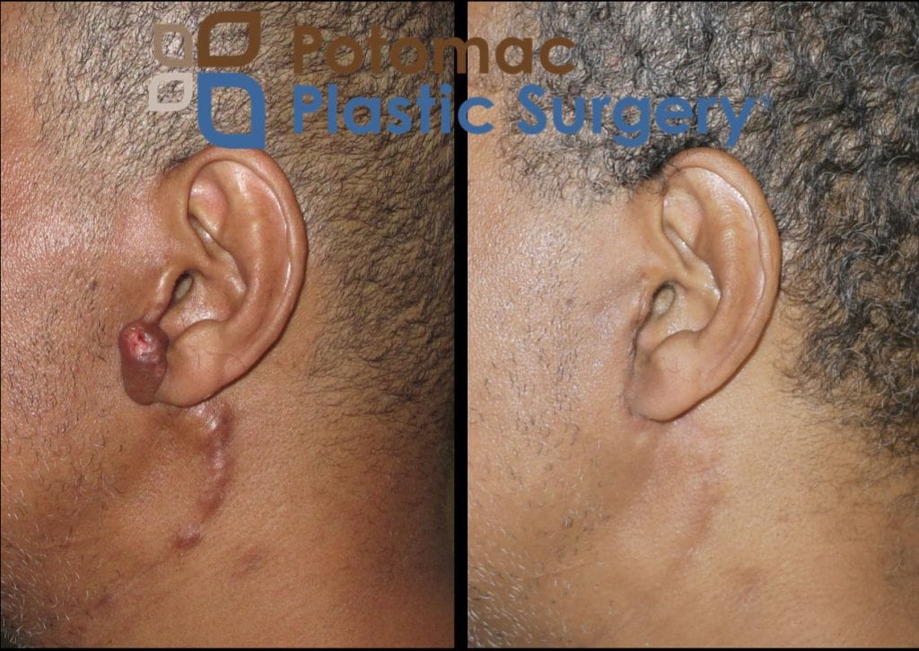 surgical scar pain plastic surgery