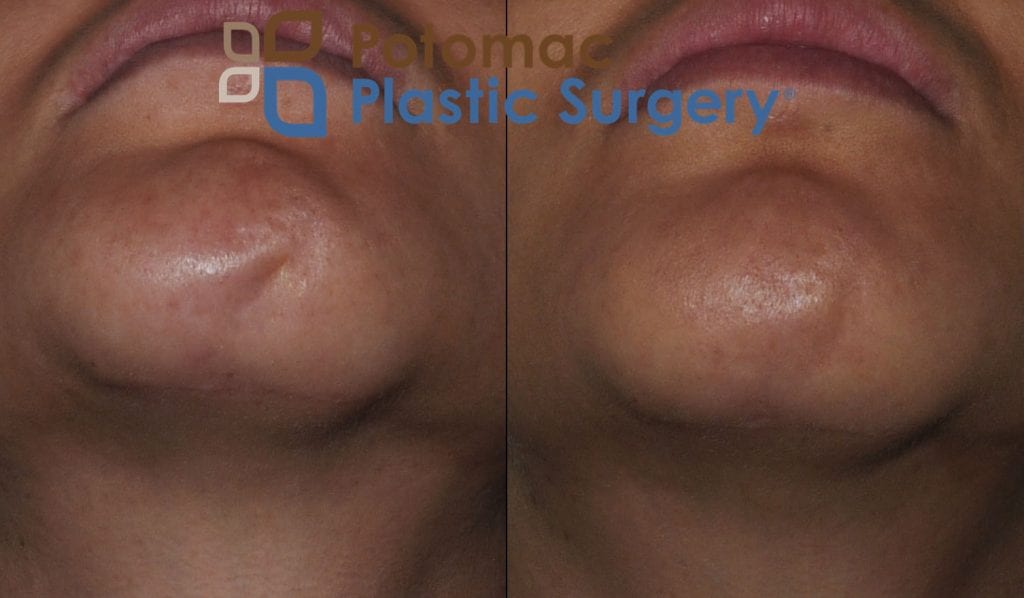 surgical scar pain plastic surgery